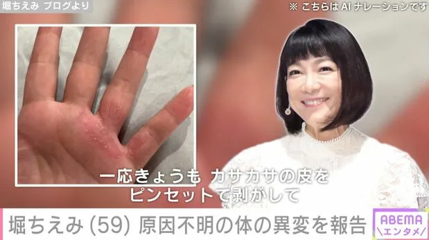 堀ちえみ59歳、原因不明の皮膚異変に「毎日症状が変わります」と悲痛